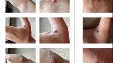 أعراض جدري القردة